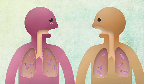 схема туберкулёза
